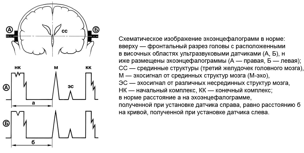 Эхо расстояние. Эхо ЭГ норма у детей показатели. Эхоэнцефалография головного мозга (Эхо-ЭГ). Эхоэнцефалография заключение норма. Эхоэнцефалография показатели нормы.